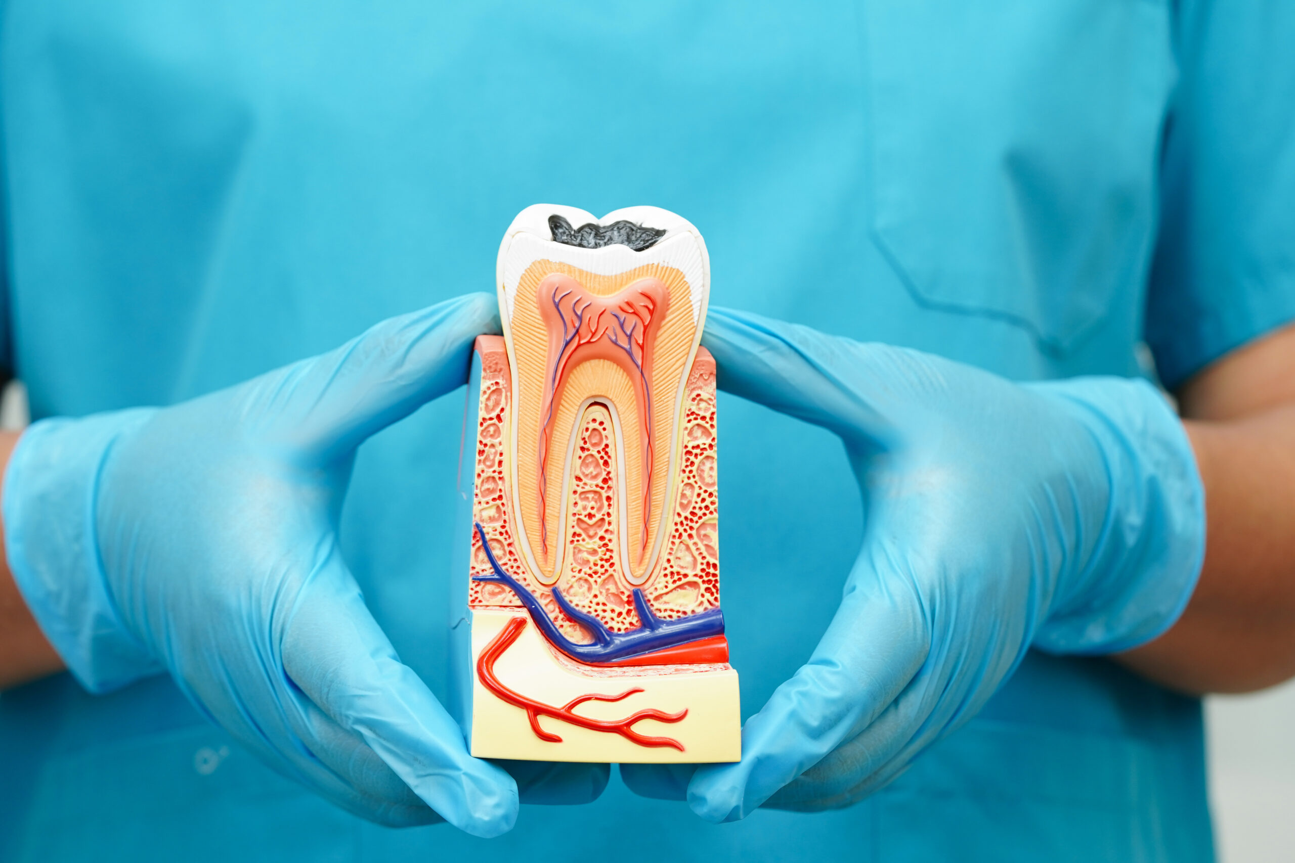 Wurzelbehandlung bei Karies